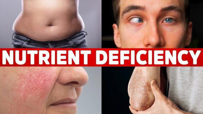 nutrient deficiencies