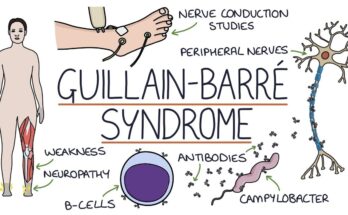 Understanding the Puzzling Guillain-Barré Syndrome